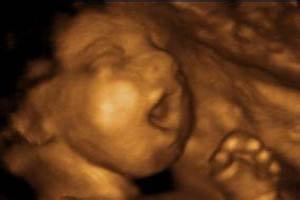 四維彩超檢查的目的